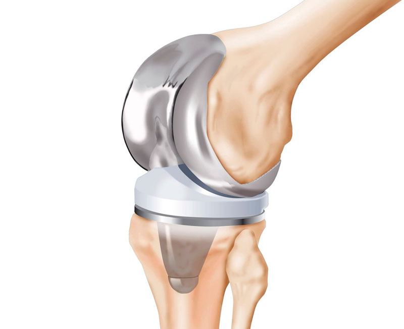  Artroplastia total do joelho